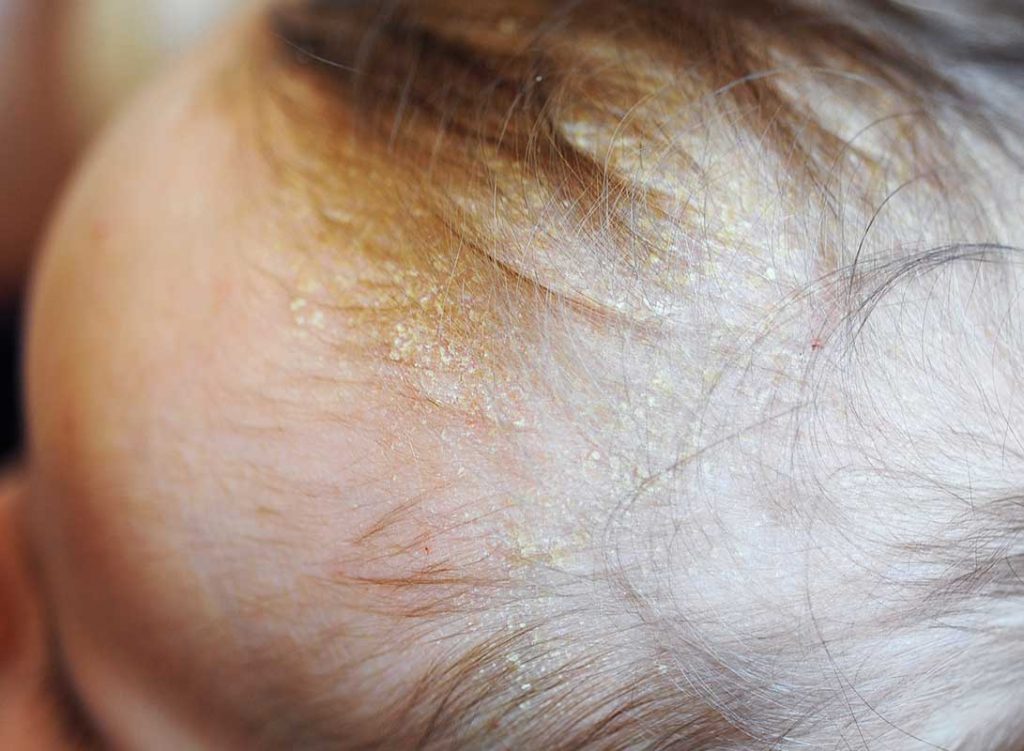قشرة راس الطفل " قبعة المهد " - Baby's cradle cap أنواع قشرة الشعر وطرق علاجها