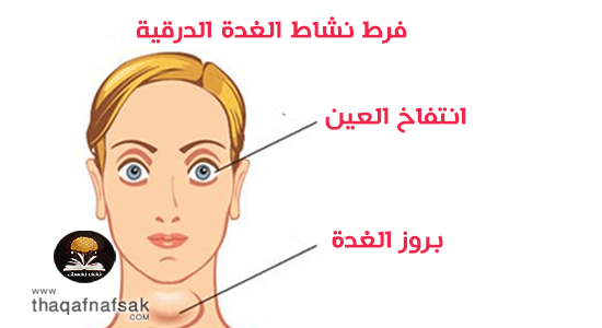تشخيص وعلاج الغدة الدرقية النشطة Thyroid activity اهل مصر