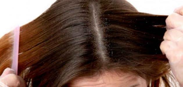 أنواع قشرة الشعر وطرق علاجها